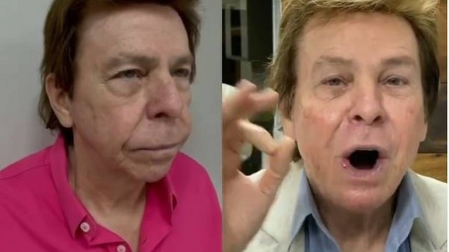 Nelson Rubens fez harmonização facial aos 83 anos Reprodução Instagram